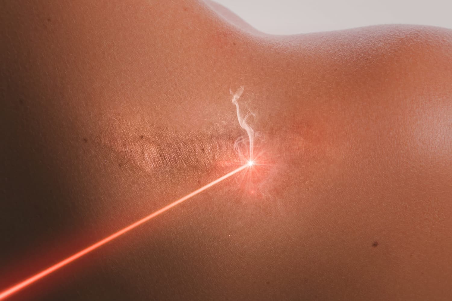Comment se déroule le traitement des cicatrices grâce au laser UltraClear ?