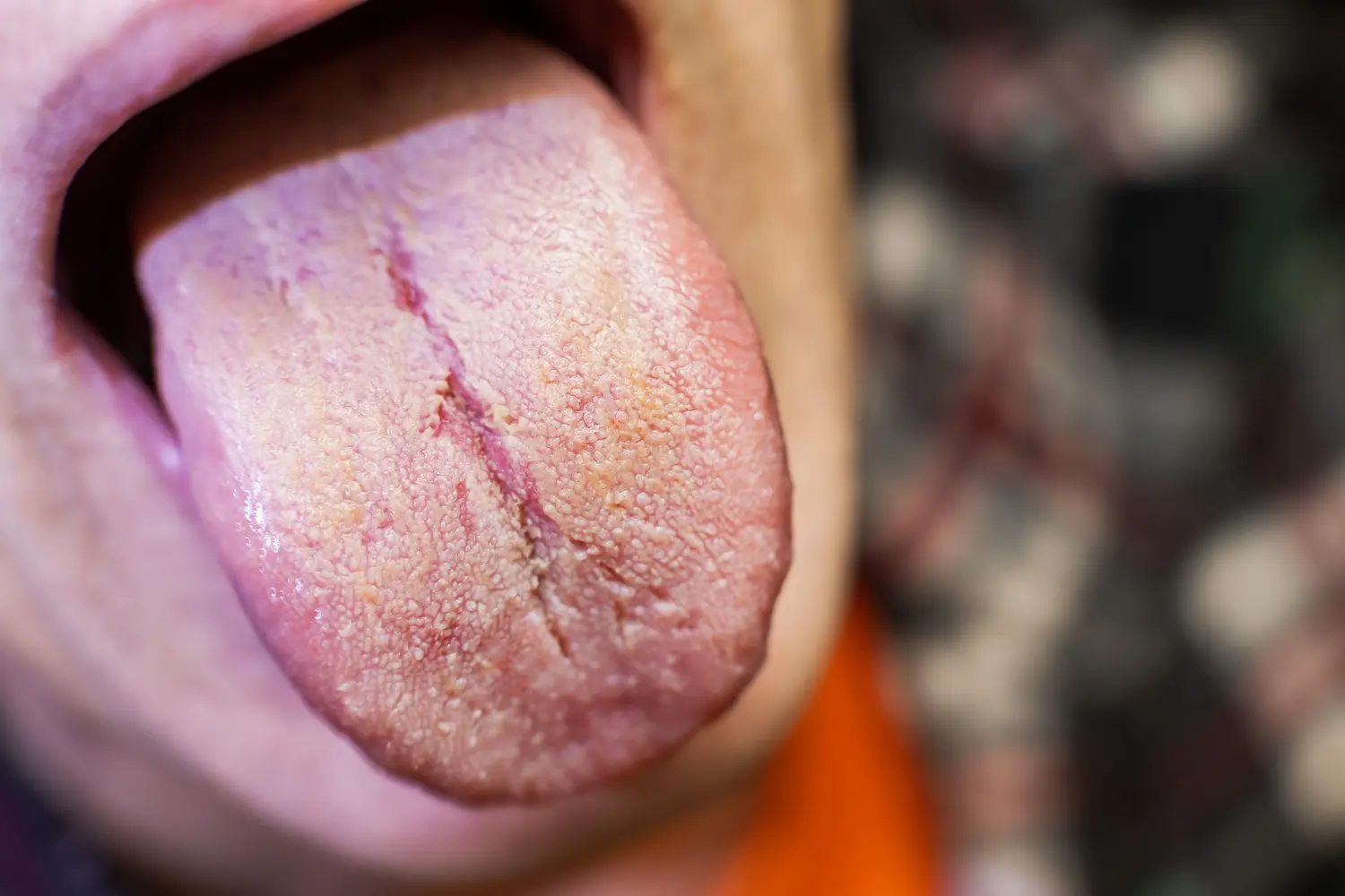 Candidose ou dysbiose : comment différencier et agir